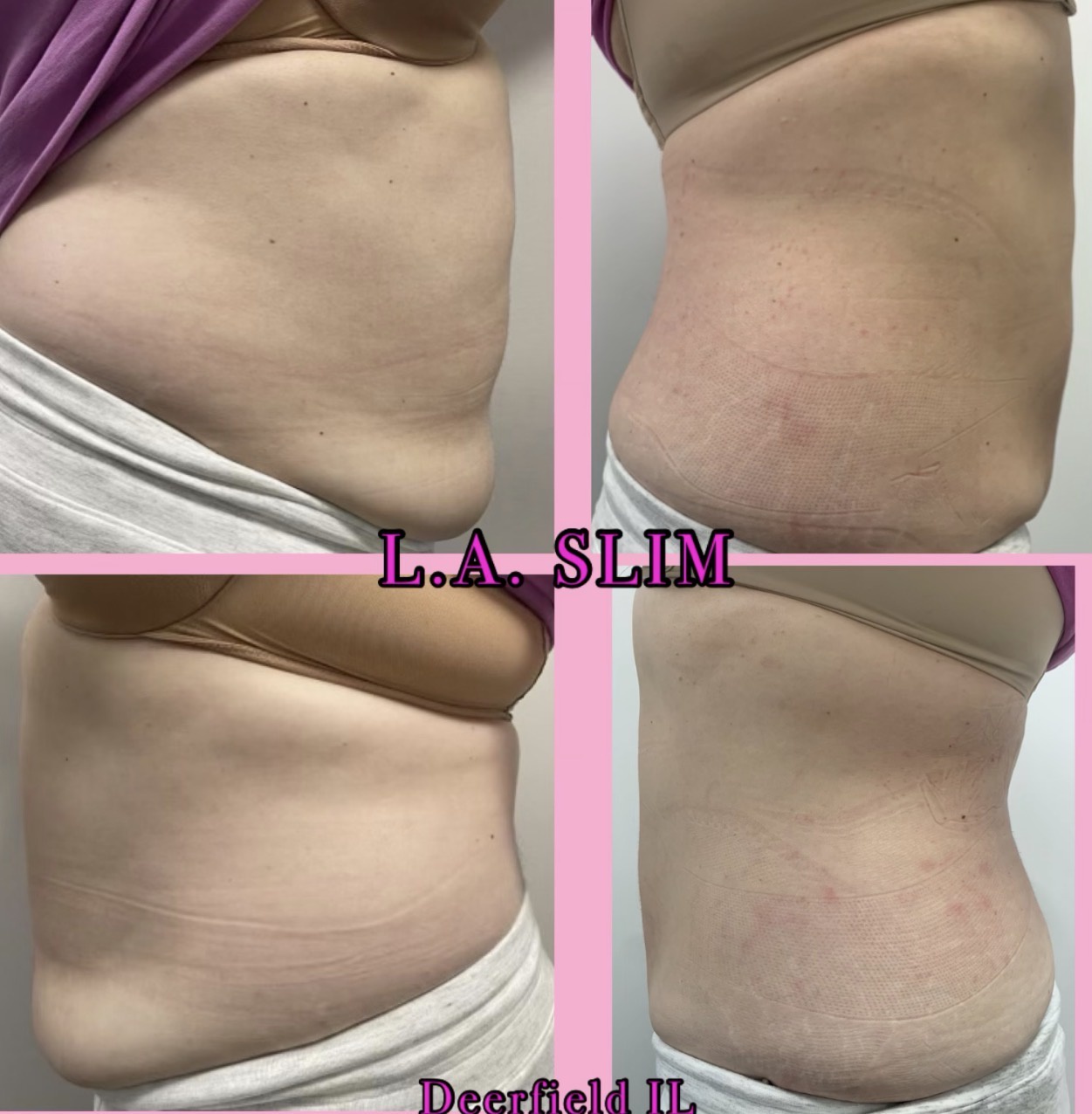 L.A. Slim abdomen contouring result