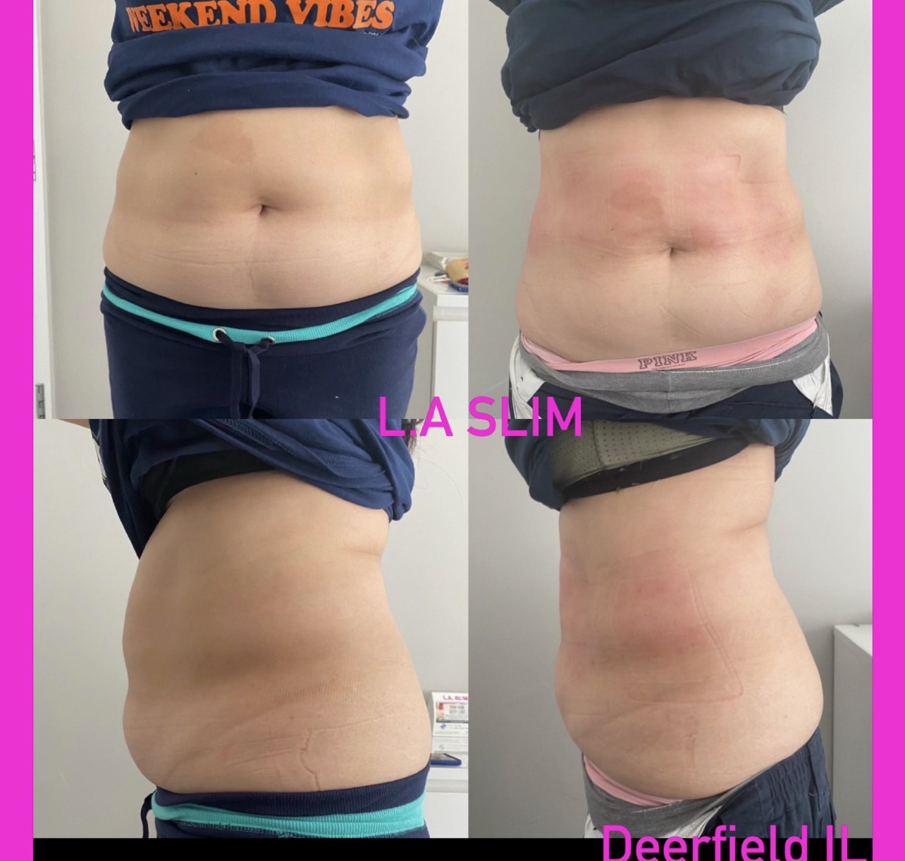 L.A. Slim abdomen contouring result