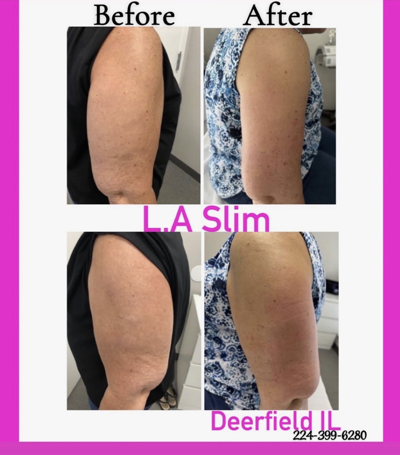L.A. Slim arm contouring result