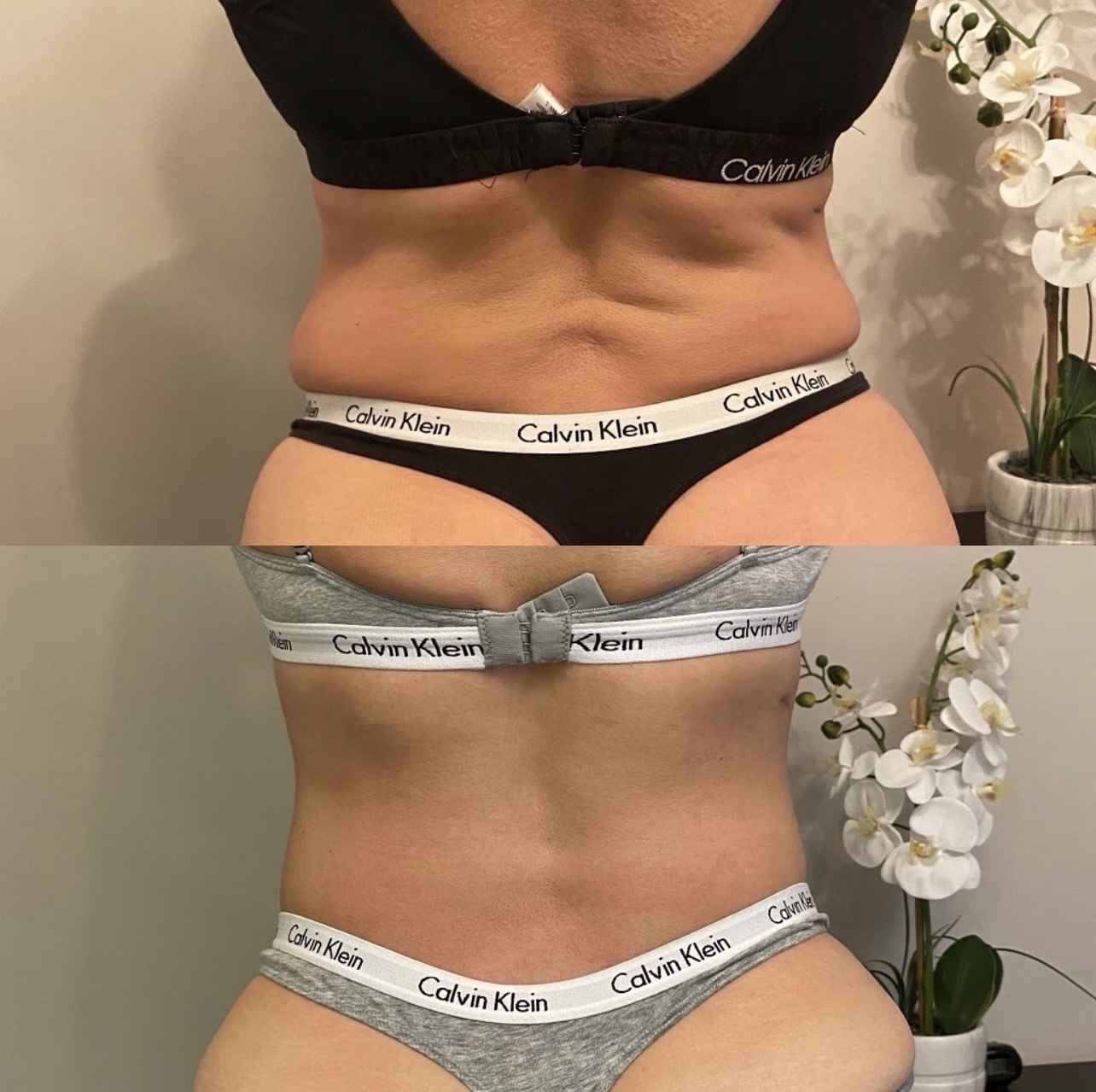 L.A. Slim waistline contouring result