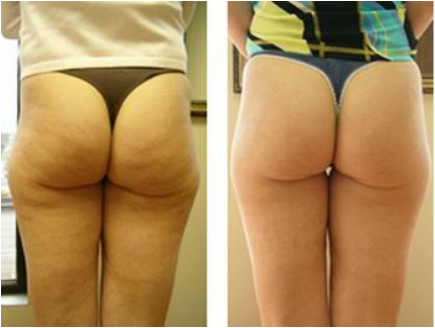 L.A. Slim cellulite reduction result