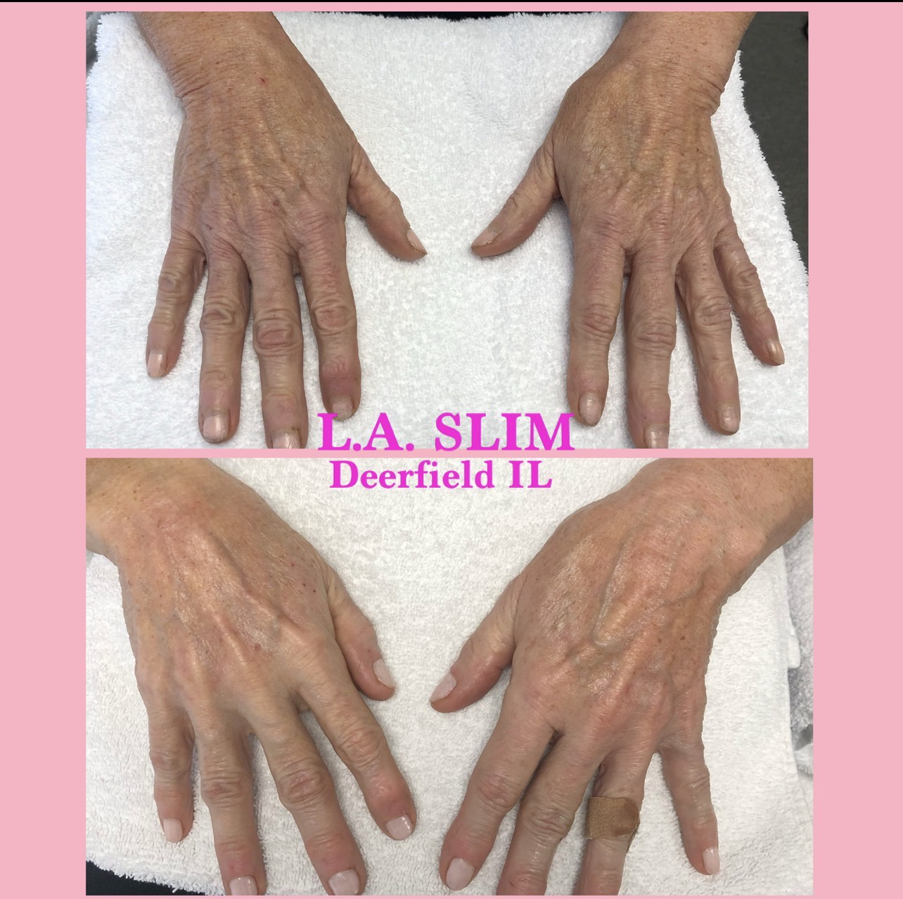 L.A. Slim hand rejuvenation result